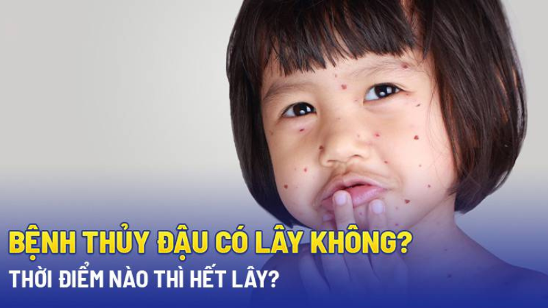 bệnh thuỷ đậu có lây không