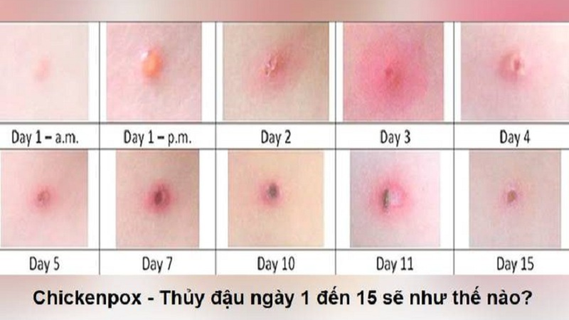 triệu chứng bệnh thuỷ đậu