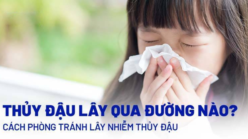 bệnh thuỷ đậu lây qua đường nào