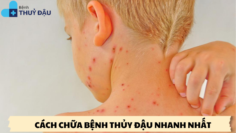 cách chữa bệnh thủy đậu nhanh nhất