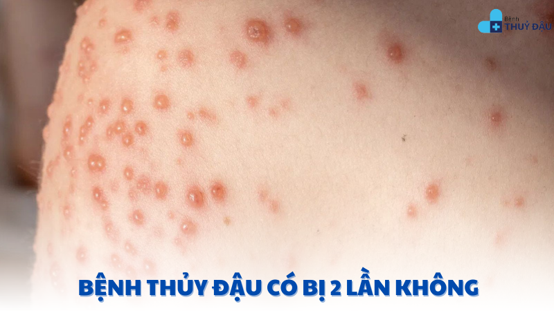 bệnh thủy đậu có bị 2 lần không