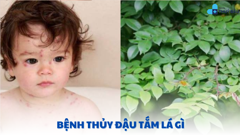 bệnh thủy đậu tắm lá gì