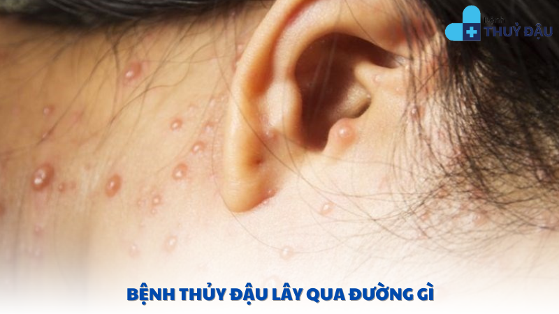 bệnh thủy đậu lây qua đường gì