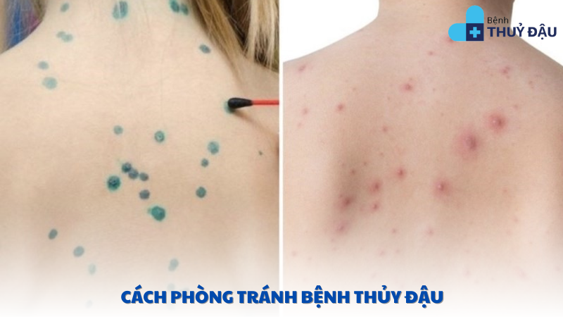 cách phòng tránh bệnh thủy đậu