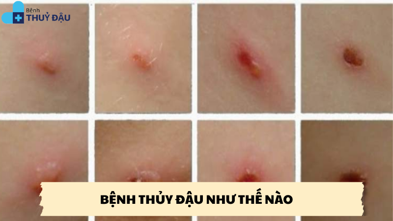bệnh thủy đậu như thế nào