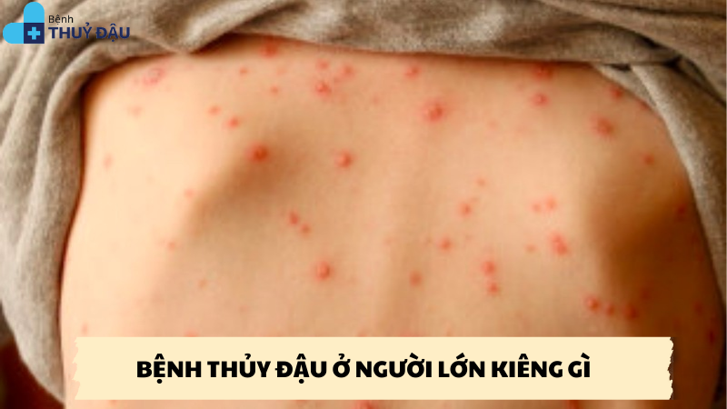 bệnh thủy đậu ở người lớn kiêng gì