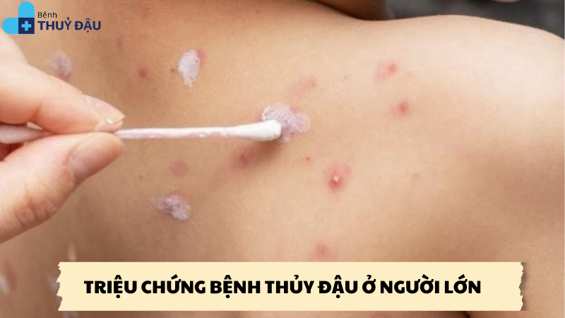 triệu chứng bệnh thủy đậu ở người lớn