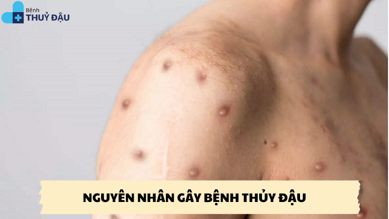 nguyên nhân gây bệnh thủy đậu